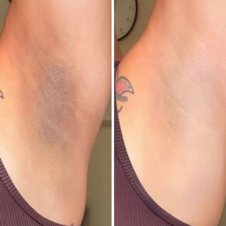 Gel esfoliante clareador