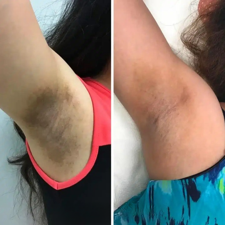 Gel esfoliante clareador